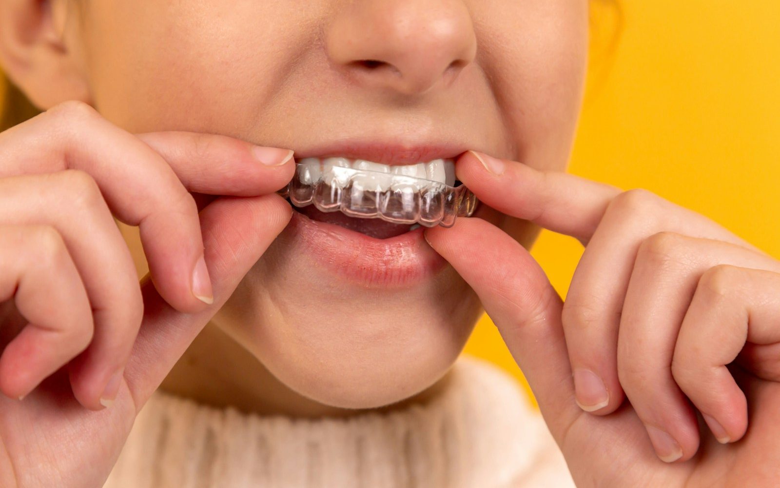 Paciente joven colocando alineador transparente Invisalign en tratamiento dental